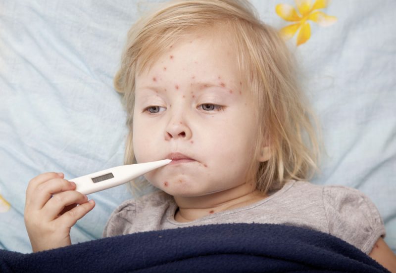 La varicelle : comment se passe la prise en charge ?